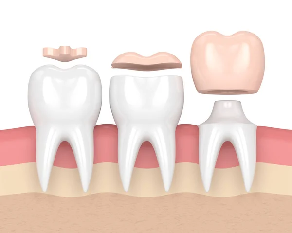 3d render of teeth with different types of dental filling — Stock Photo, Image