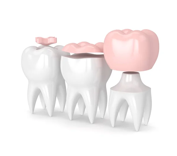 3d render of teeth with different types of filling — Stock Photo, Image
