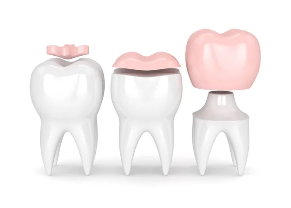 3D-Darstellung von Zähnen mit verschiedenen Füllungsarten — Stockfoto