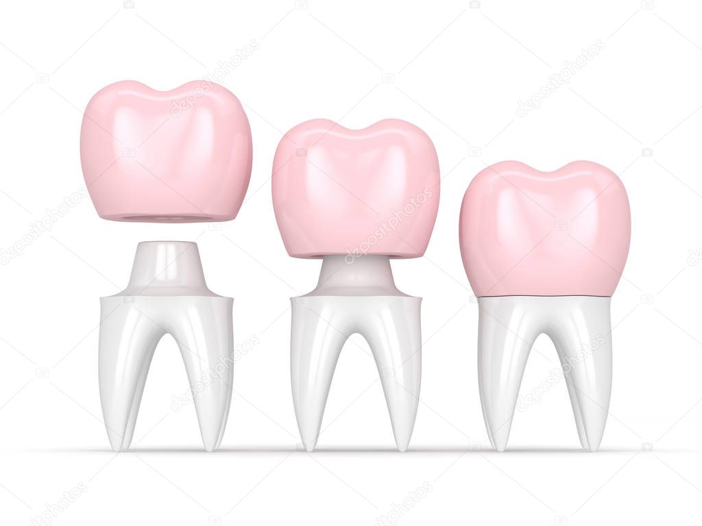 3d render of  replacement crown cemented onto reshaped tooth