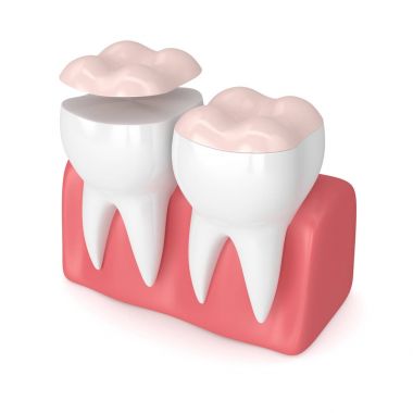 diş diş onlay ile 3D render