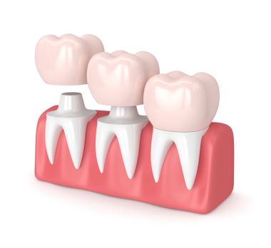 3D render üzerine çimentolu değiştirme kronlar diş yeniden şekillenen