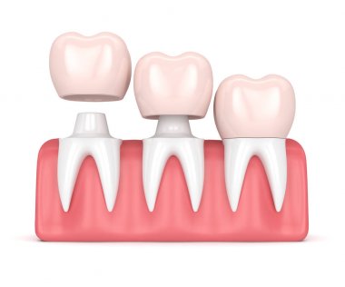 3D render üzerine çimentolu değiştirme kronlar diş yeniden şekillenen