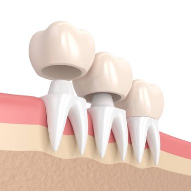 3D render üzerine çimentolu değiştirme kronlar diş yeniden şekillenen