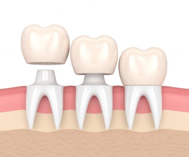 3D render üzerine çimentolu değiştirme kronlar diş yeniden şekillenen