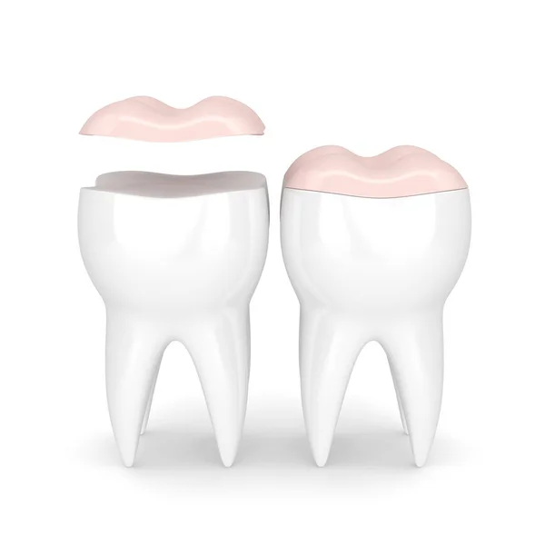 3d renderizado de dientes con onlay dental — Foto de Stock