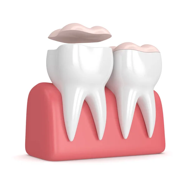 3d render of teeth with dental onlay — Stock Photo, Image