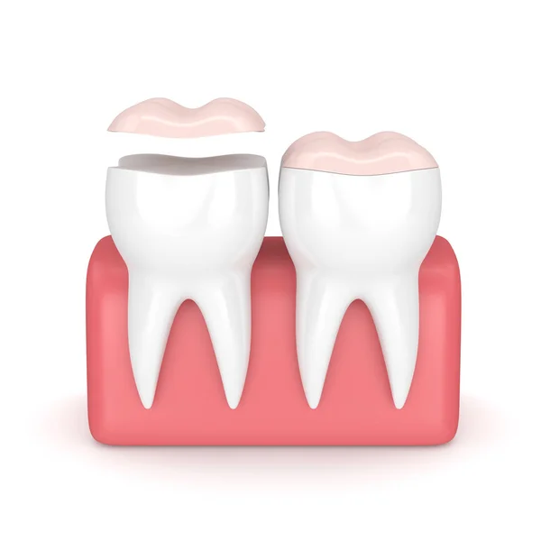 3d render of teeth with dental onlay — Stock Photo, Image