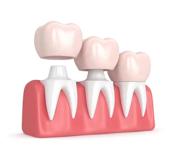 3d renderizado de coronas de reemplazo cementado en dientes remodelados — Foto de Stock