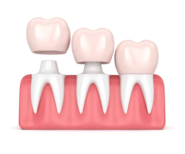 3d render of  replacement crowns cemented onto reshaped teeth — Stock Photo, Image