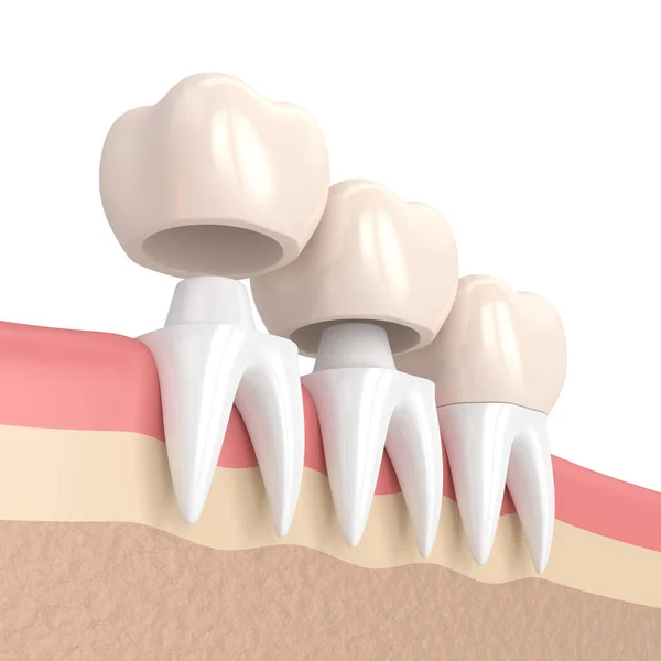 3d render of  replacement crowns cemented onto reshaped teeth — Stock Photo, Image