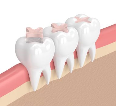 3d render of teeth with dental inlay filling clipart
