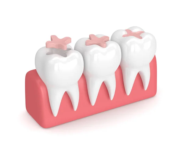 3d render de dientes con relleno de incrustaciones dentales — Foto de Stock