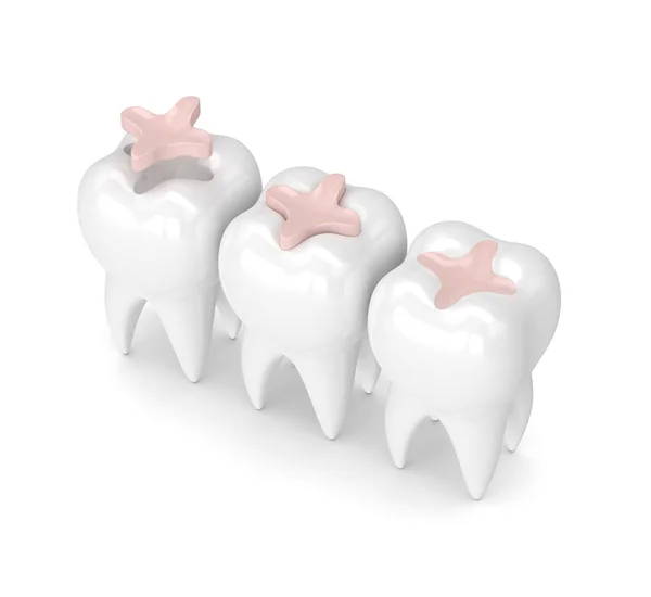 3d render de dientes con relleno de incrustaciones dentales — Foto de Stock