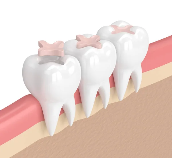 3d render of teeth with dental inlay filling — Stock Photo, Image