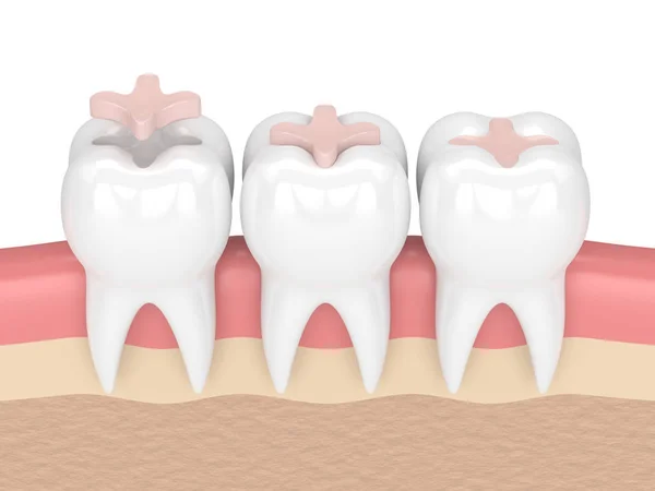 3d render of teeth with dental inlay filling — Stock Photo, Image