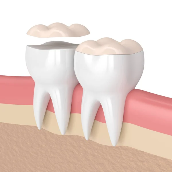 3d renderizado de dientes con onlay dental — Foto de Stock