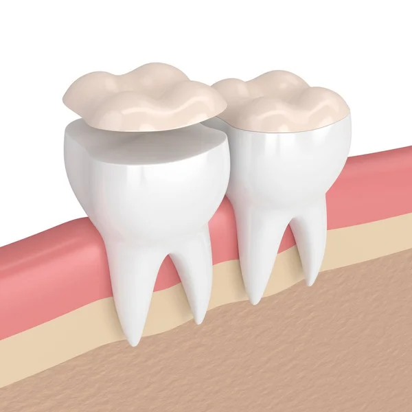 3d render of teeth with dental onlay — Stock Photo, Image