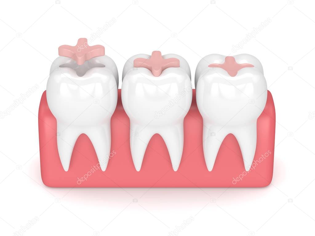 3d render of teeth with dental inlay filling