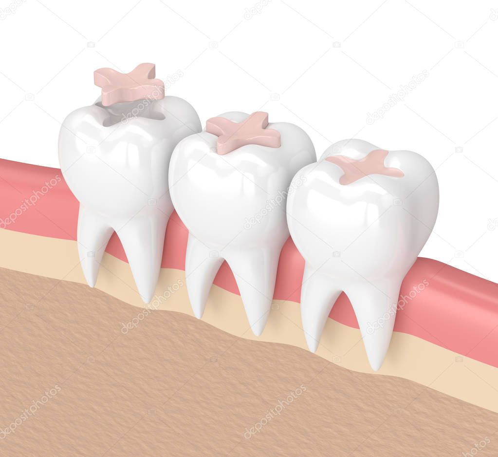 3d render of teeth with dental inlay filling