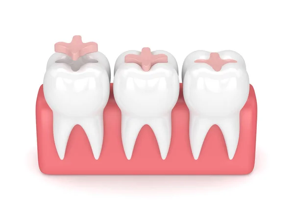 3d render de dientes con relleno de incrustaciones dentales — Foto de Stock