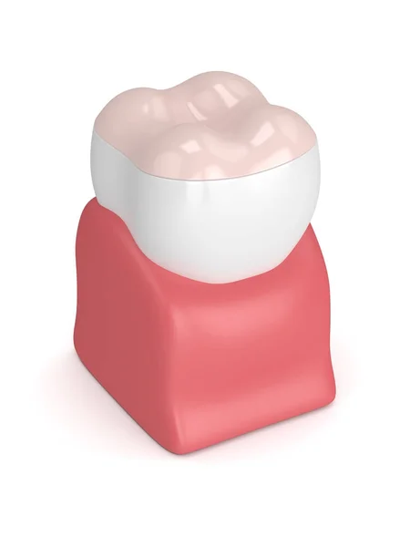 3d рендеринг зуба с зубной накладкой — стоковое фото