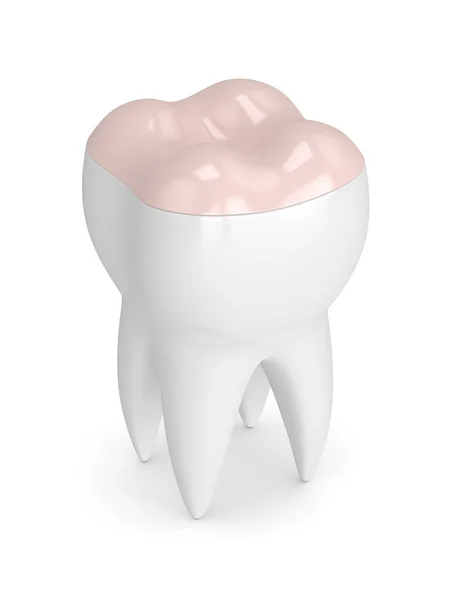 3D візуалізація зуба з зубною накладкою — стокове фото