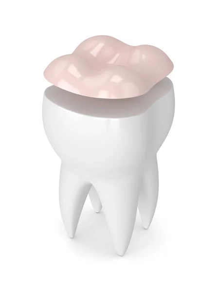 3d рендеринг зуба с зубной накладкой — стоковое фото
