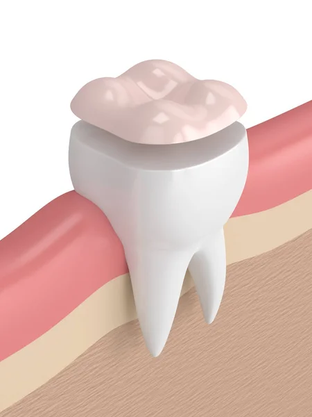 3d render of tooth with dental onlay filling — Stock Photo, Image