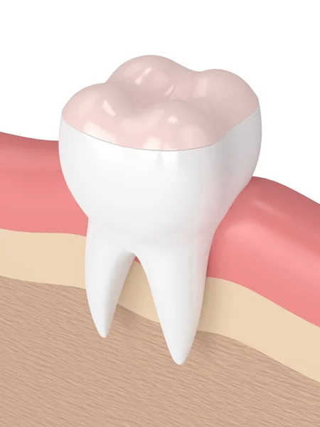 3d render of tooth with dental onlay filling — Stock Photo, Image