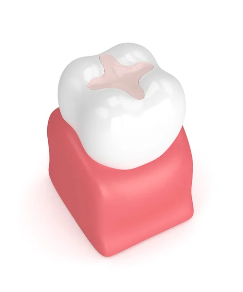 3D vykreslování zubu s výplní zubní vložka — Stock fotografie