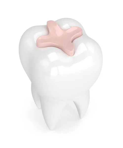 3d render of tooth with dental inlay filling — Stock Photo, Image