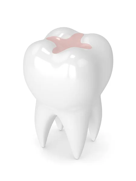 3d rendu de dent avec incrustation dentaire remplissage — Photo