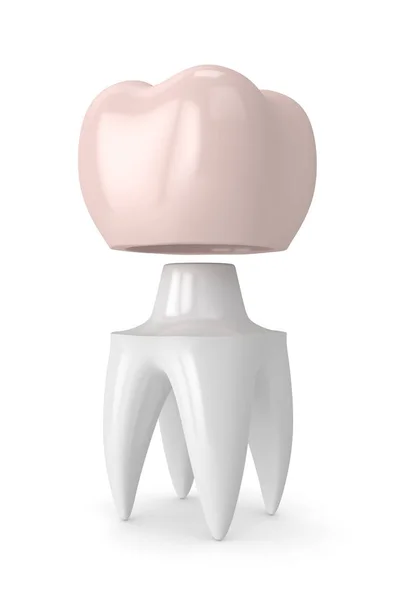3D render zęba z korony dentystyczne — Zdjęcie stockowe