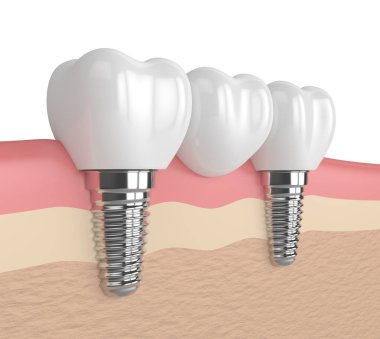 3D render implantları diş köprü desteklenen 