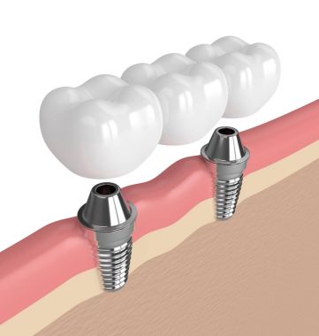 3D render implantları diş köprü desteklenen 