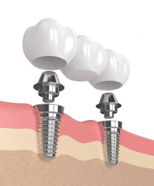 3D render implantları diş köprü desteklenen 