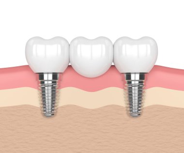 3D render implantları diş köprü desteklenen 