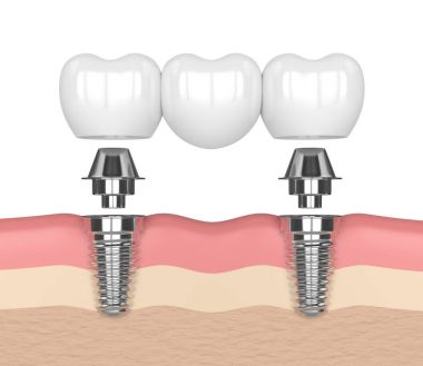 3D render implantları diş köprü desteklenen 