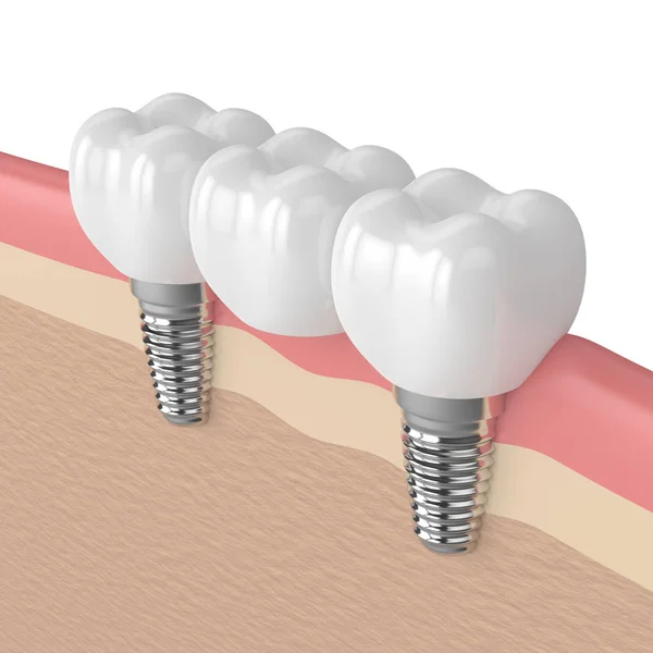 3D візуалізація імплантатів, підтримуваних стоматологічним мостом — стокове фото