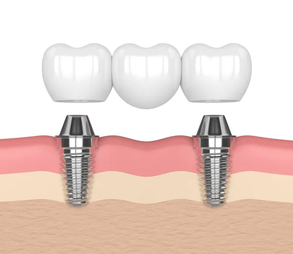 3D візуалізація імплантатів, підтримуваних стоматологічним мостом — стокове фото
