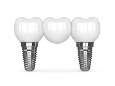 implantlar diş köprü ile 3D render 
