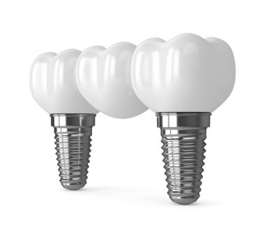 implantlar diş köprü ile 3D render 
