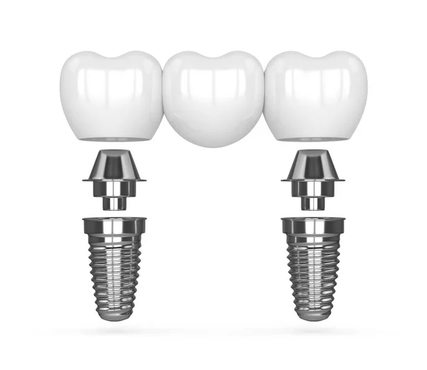 3d renderização de implantes com ponte dentária — Fotografia de Stock