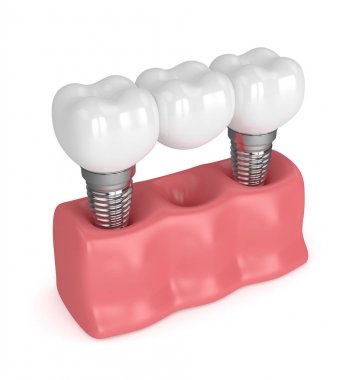 implantlar diş köprü ile 3D render 