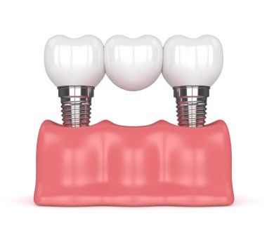 implantlar diş köprü ile 3D render 