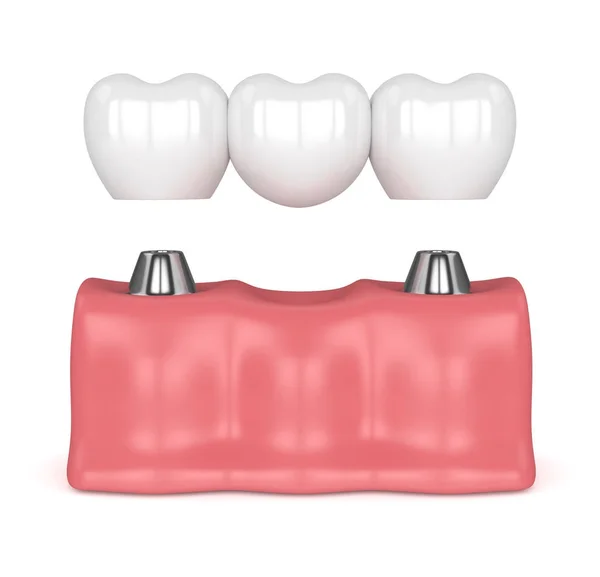 3D renderizado de implantes con puente dental — Foto de Stock