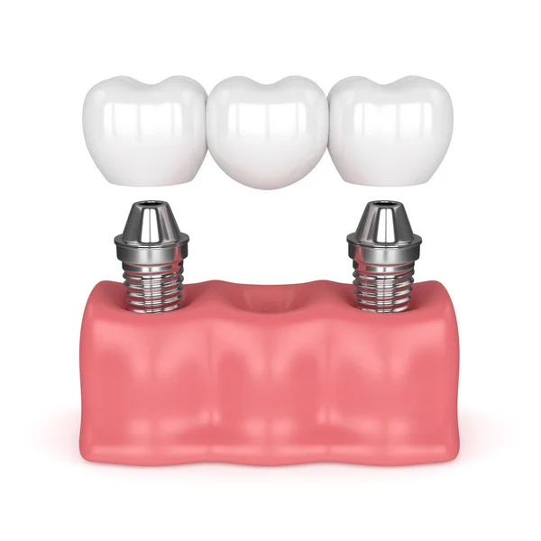 3D рендеринг имплантатов с зубным мостом — стоковое фото