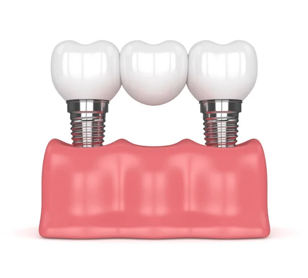 3D-Rendering von Implantaten mit Zahnbrücke — Stockfoto