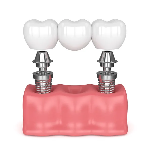 3D render az implantátumok, fogászati híd — Stock Fotó